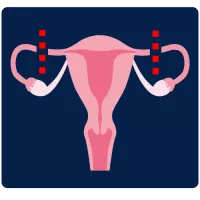 image representation of tubal sterilization, a uterus with dotted red lines showing where the tubes would be cut