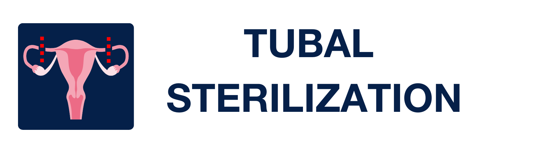 Tubal Sterilization