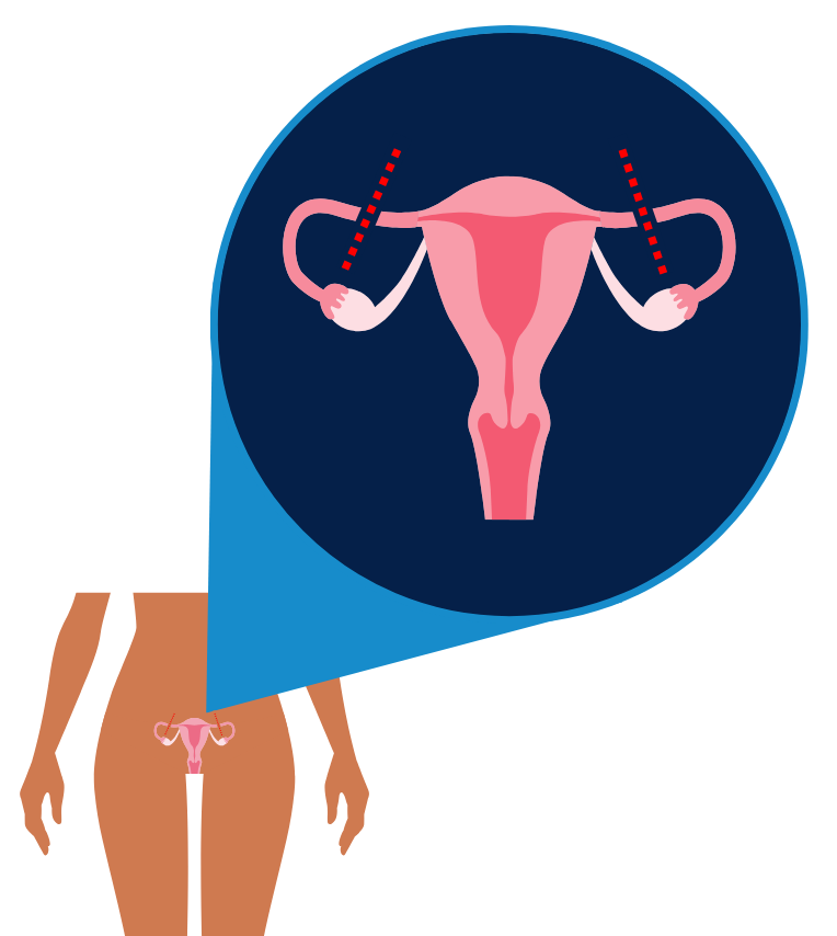 an image zooming in on a uterus, showing the tubes blocked or cut during tubal sterilization