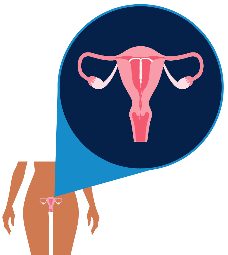 an image zooming in on a uterus containing the hormonal IUD