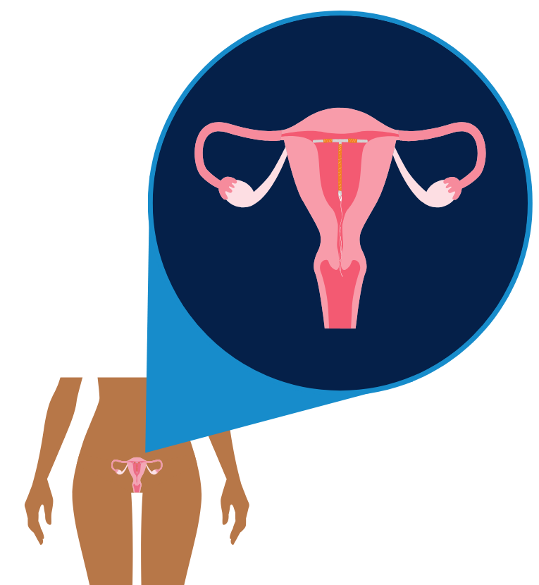 an image zooming in on a uterus, containing the non-hormonal, copper IUD