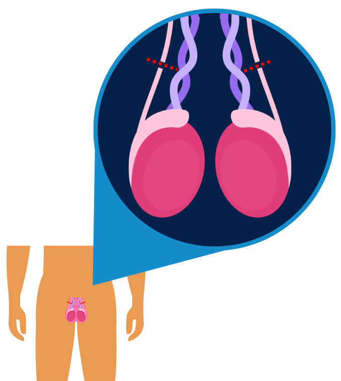 an image zooming in on the inside of the scrotum, or “balls”, showing the tubes blocked or cut during a vasectomy